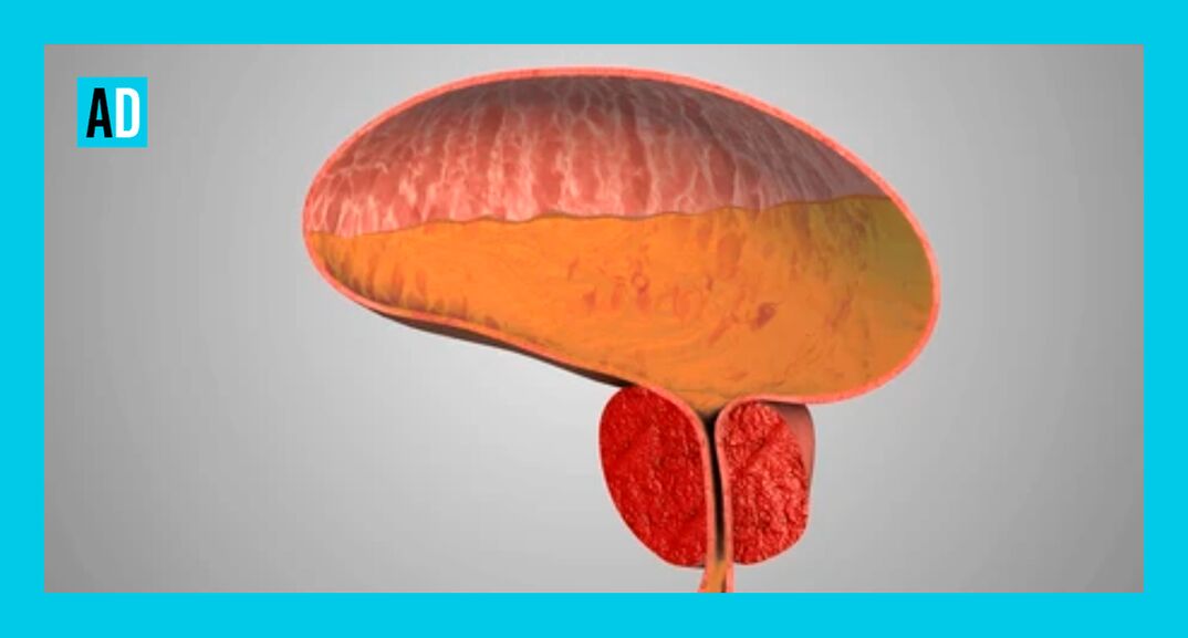 Φλεγμονή του προστάτη